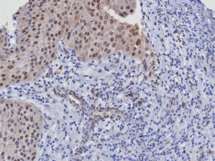 Formalin-fixed, paraffin-embedded human bladder cancer stained with CDK4 Antibody (CDK4/8351R). HIER: Tris/EDTA, pH9.0, 45min. 2�C: HRP-polymer, 30min. DAB, 5min.