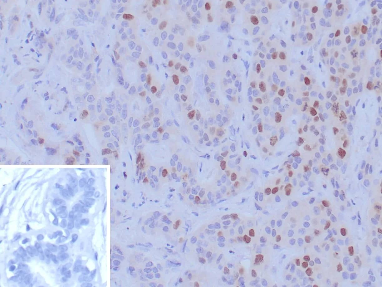Formalin-fixed, paraffin-embedded human breast carcinoma stained with BRCA1 Antibody (BRCA1/9797R). Inset: PBS instead of primary antibody; secondary only negative control.