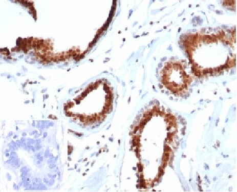Formalin-fixed, paraffin-embedded human breast carcinoma stained with p27/Kip1 Antibody (rKIP1/1356). Inset: PBS instead of primary antibody. Secondary negative control.