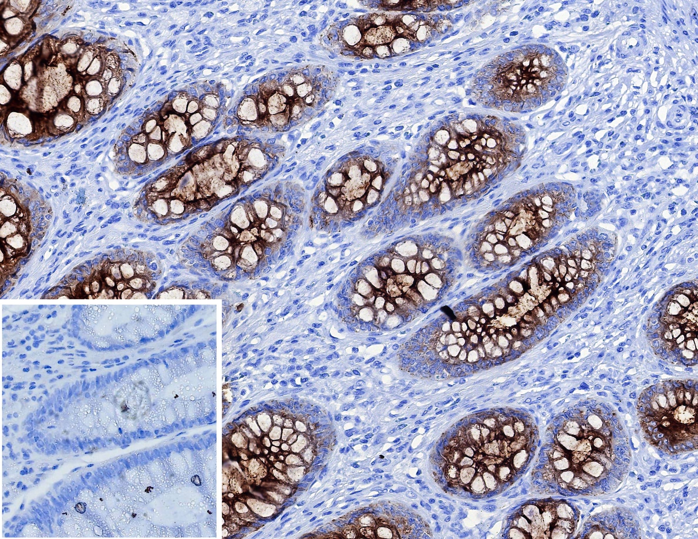 Formalin-fixed, paraffin-embedded human colon carcinoma stained with CEACAM5/CD66e Antibody (C66/1983R). Inset: PBS instead of primary antibody; secondary only negative control.