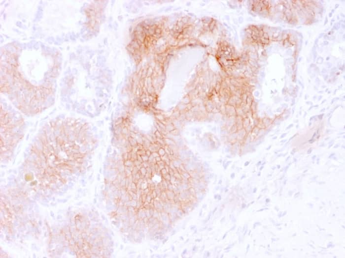 Formalin-fixed, paraffin-embedded human Prostate Carcinoma stained with CD44, variant 6 Antibody (2F10).