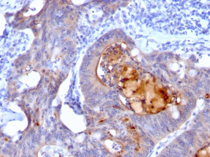 Formalin-fixed, paraffin-embedded human Colon Carcinoma stained with ECM-1/Secretory Component P85 Antibody (rECM1/792).