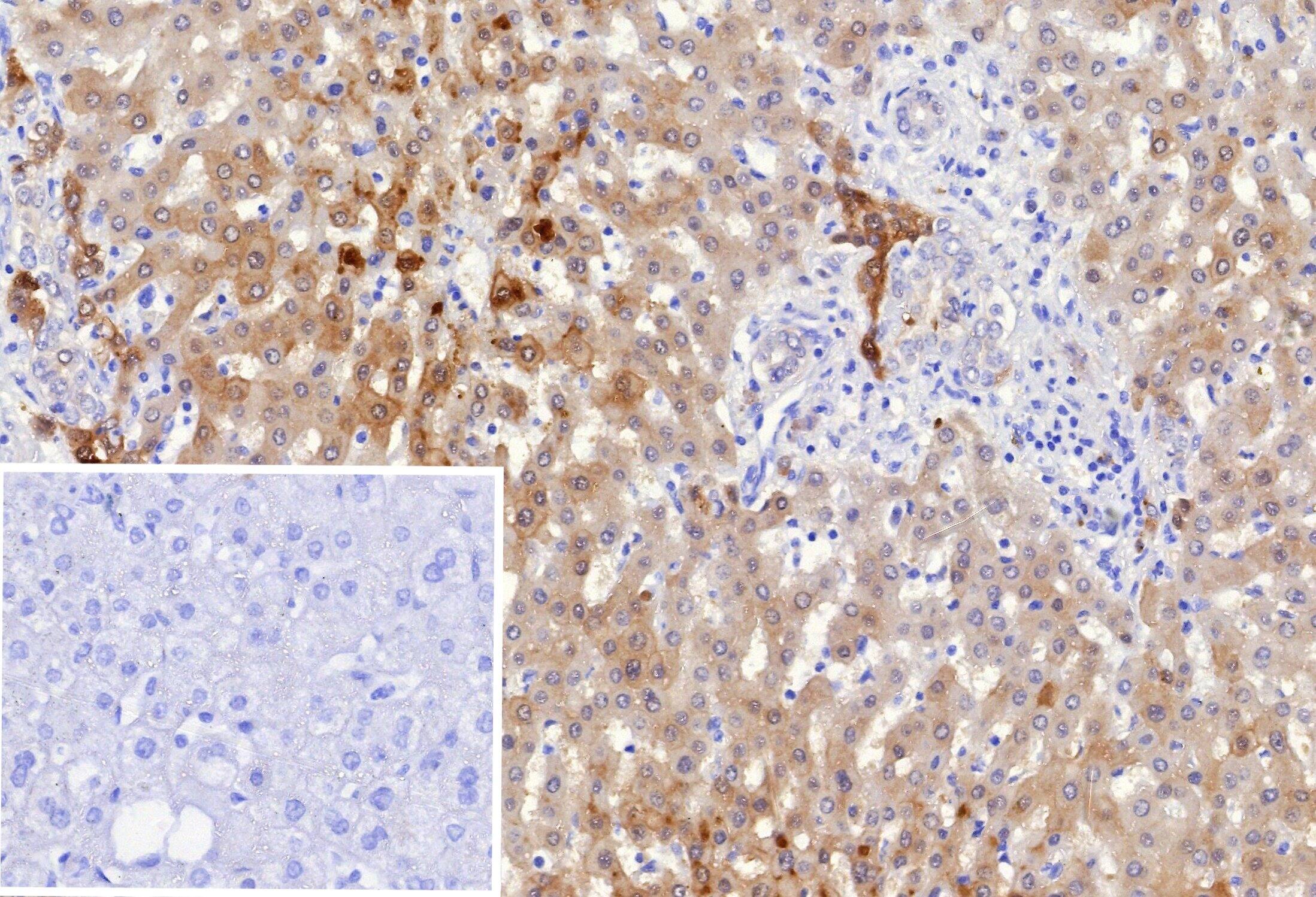 Formalin-fixed, paraffin-embedded human hepatocellular carcinoma (HCC) stained with Aldo-keto Reductase 1C1/AKR1C1 Antibody (AKR1C1/9318). Inset: PBS instead of primary antibody; secondary only negative control.