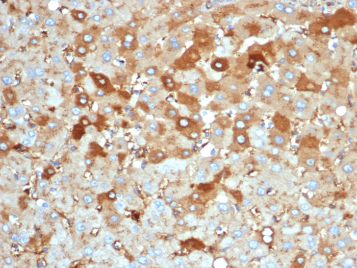 Formalin-fixed, paraffin-embedded human liver carcinoma in colon stained with Albumin Antibody (rALB/6414).
