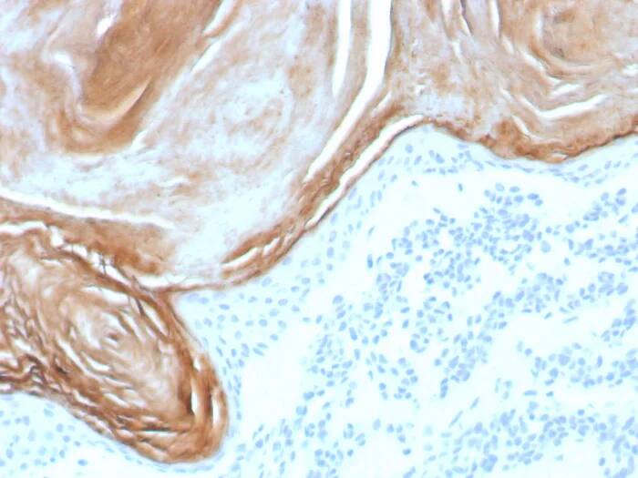 Formalin-fixed, paraffin-embedded human skin stained with Kallikrein 7 Antibody (KLK7/8971R). HIER: Tris/EDTA, pH9.0, 45min. 2�C: HRP-polymer, 30min. DAB, 5min.