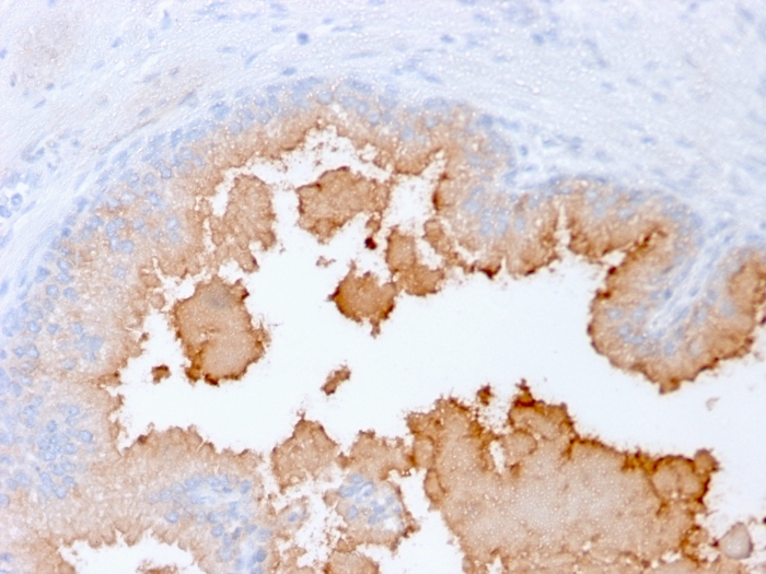 Formalin-fixed, paraffin-embedded human prostate carcinoma stained with alpha-Methylacyl-CoA Racemase/AMACR Antibody (rAMACR/1864). HIER: Tris/EDTA, pH9.0, 45min. 2�C: HRP-polymer, 30min. DAB, 5min.