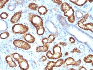 Formalin-fixed, paraffin-embedded human renal cell carcinoma stained with alpha-Methylacyl-CoA Racemase/AMACR Antibody (AMACR/3931R).