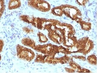 Formalin-fixed, paraffin-embedded human prostate carcinoma stained with alpha-Methylacyl-CoA Racemase/AMACR Antibody (AMACR/3931R).