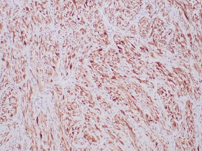 Formalin-fixed, paraffin-embedded human inflammatory myofibroblastic tumor stained with ALK/CD246 Antibody (ALK1/6698R) at 2ug/ml. HIER: Tris/EDTA pH9.0; 95°C/45min. 2�CAb: HRP-Poly:30min. DAB:5min.