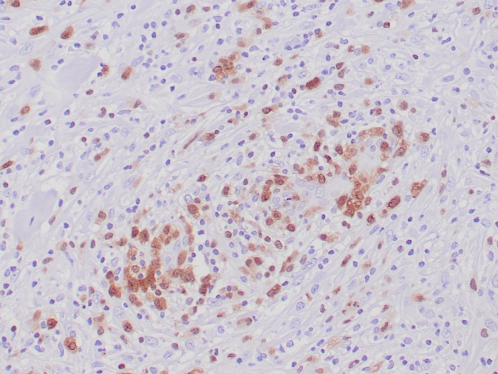 Formalin-fixed, paraffin-embedded human Anaplastic Large Cell Lymphoma stained with ALK/CD246 Antibody (ALK1/6698R) at 2ug/ml. HIER: Tris/EDTA pH9.0; 95°C/45min. 2�CAb: HRP-Poly:30min. DAB:5min.