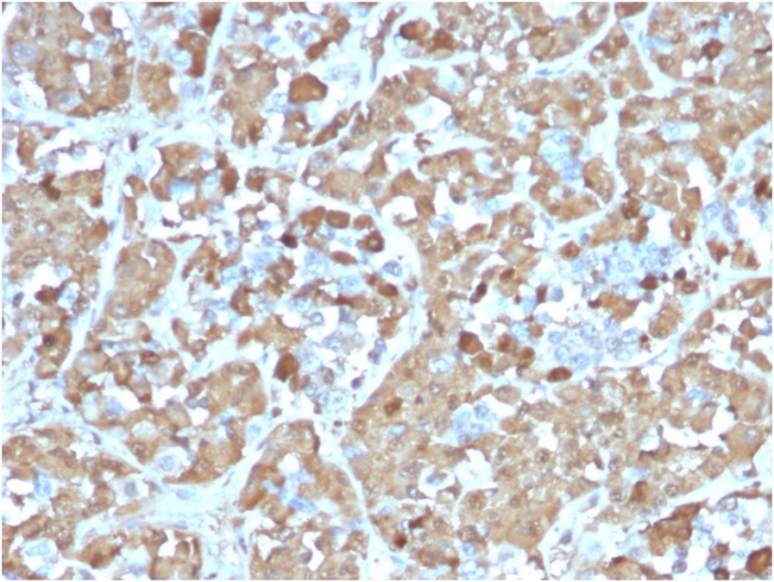Formalin-fixed, paraffin-embedded human Pituitary stained with Growth Hormone Antibody (rGH/1450).