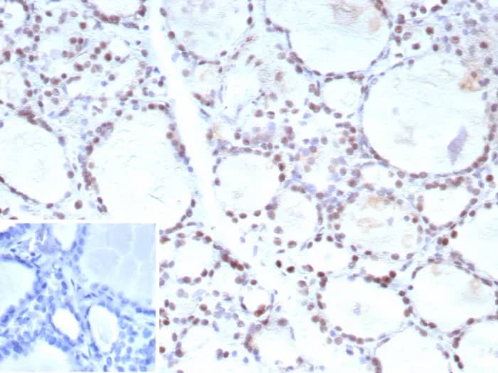 Formalin-fixed, paraffin-embedded human prostate carcinoma stained with FoxP1 Antibody (FOXP1/9381R). Inset: PBS instead of primary antibody; secondary only negative control.