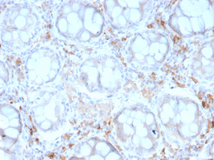 Formalin-fixed, paraffin-embedded human Colon Carcinoma stained with DC-SIGN/CD209 Antibody (rC209/1781).
