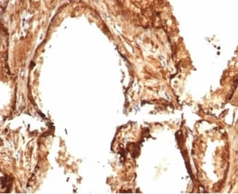 Formalin-fixed, paraffin-embedded human prostate stained with HSP27 Antibody (HSPB1/7038R). HIER: Tris/EDTA, pH9.0, 45min. 2�C: HRP-polymer, 30min. DAB, 5min.