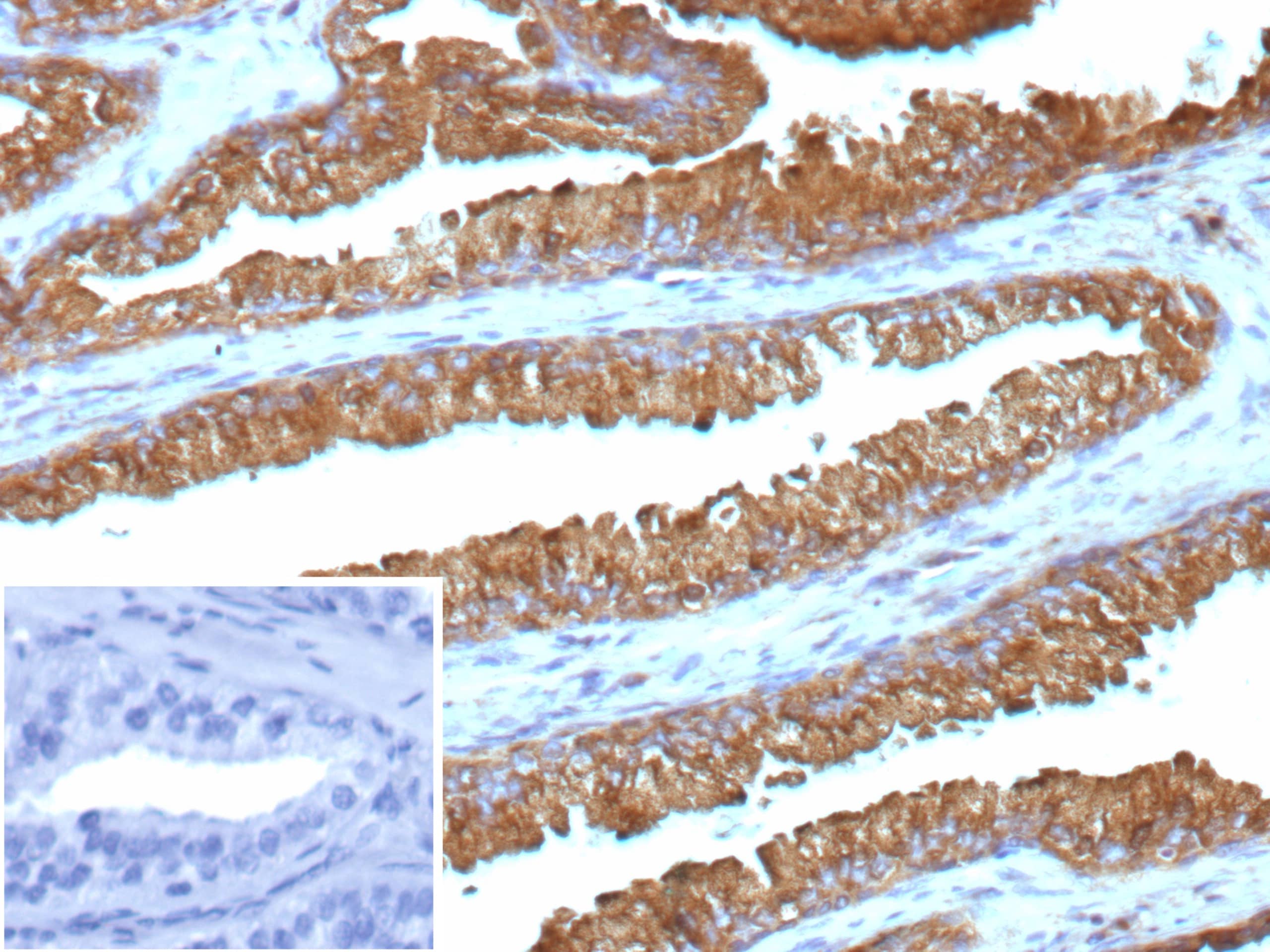 Formalin-fixed, paraffin-embedded human prostate cancer stained with Isocitrate Dehydrogenase 1/IDH1 Antibody (IDH1.R132G/13054R). Inset: PBS instead of primary antibody; secondary only negative control. 