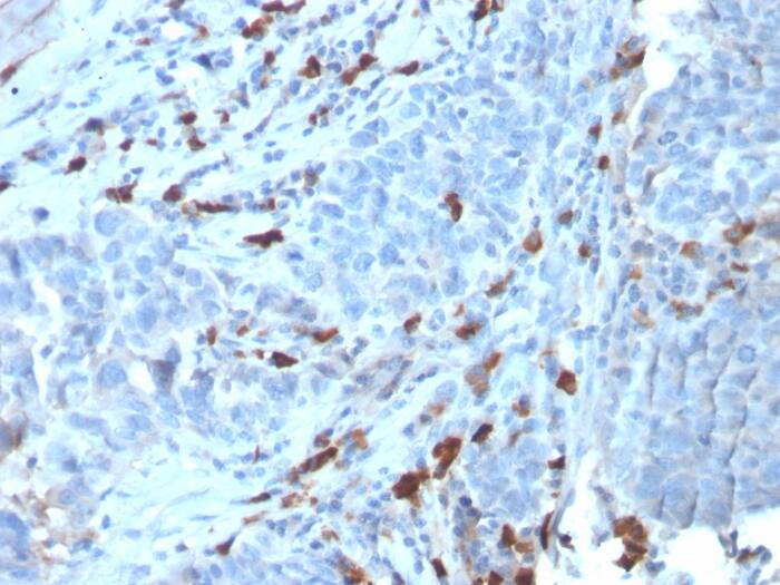 Formalin-fixed, paraffin-embedded human Tumor stained with IgM Antibody (IGHM/3135R).