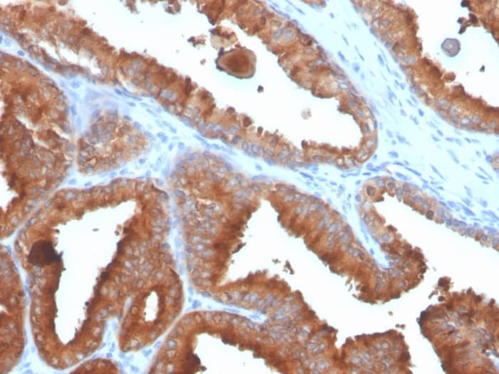 Formalin-fixed, paraffin-embedded human prostate carcinoma stained with Kallikrein 3/PSA Antibody (rKLK3/4753) - Azide and BSA Free.