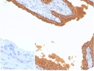 Formalin-fixed, paraffin-embedded human prostate carcinoma stained with Kallikrein 3/PSA Antibody (KLK3/7128R) - Azide and BSA Free at 2ug/ml. Inset: PBS instead of primary antibody; secondary only negative control.