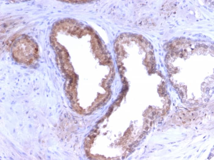 Formalin-fixed, paraffin-embedded human Prostate Carcinoma stained with Kallikrein 3/PSA Antibody (KLK3/2871R) - Azide and BSA Free.