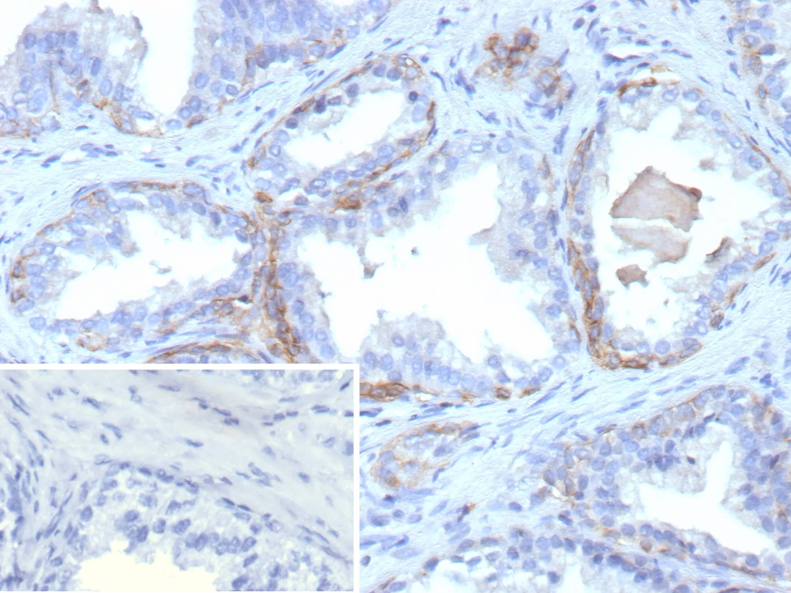 Formalin-fixed, paraffin-embedded human prostate carcinoma stained with Cytokeratin 13 Antibody (rKRT13/9623) - Azide and BSA Free. Inset: PBS instead of primary antibody; secondary only negative control. 