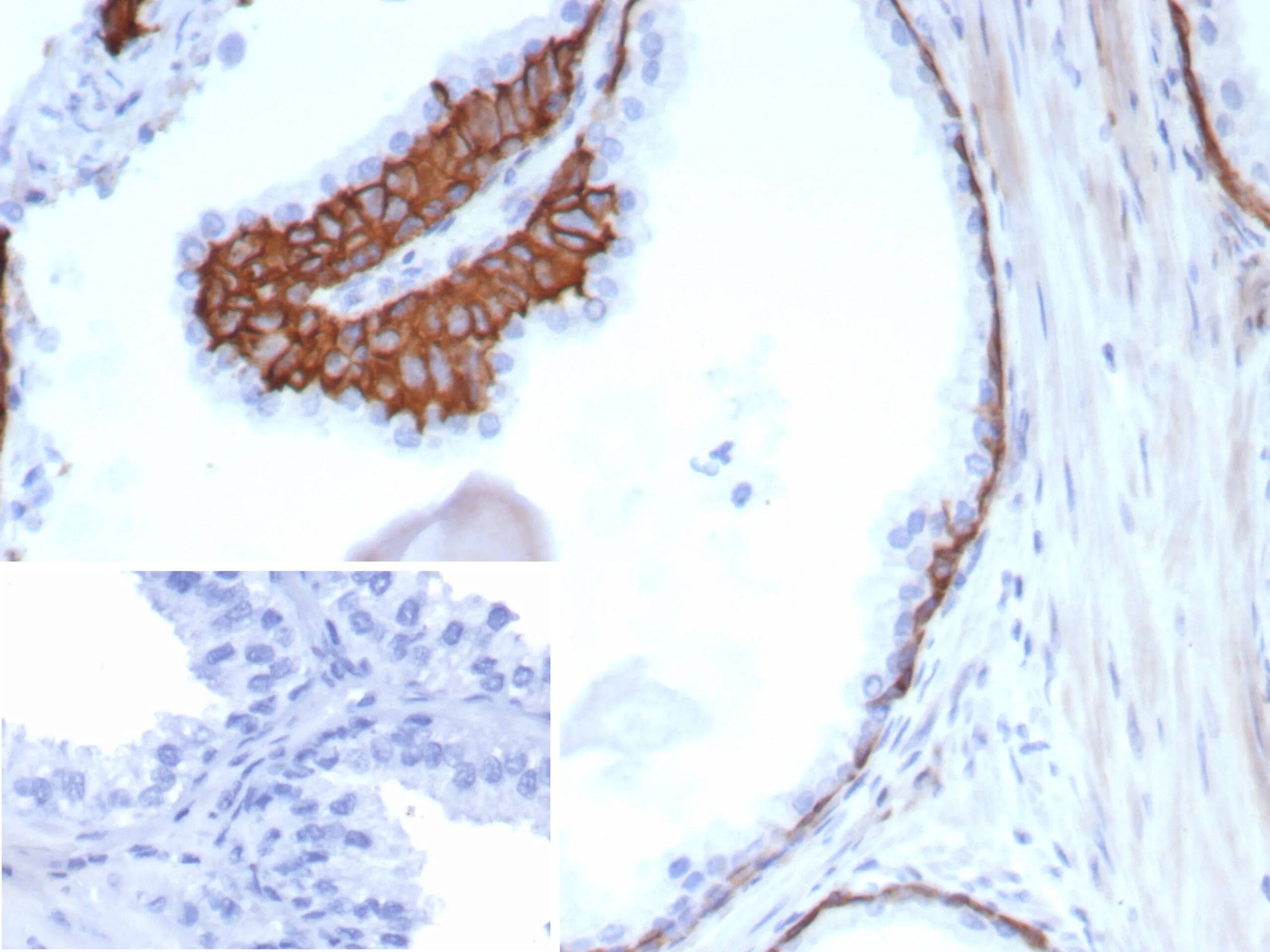 Formalin-fixed, paraffin-embedded human prostate stained with Cytokeratin 13 Antibody (KRT13/8577R) - Azide and BSA Free. Inset: PBS instead of primary antibody; secondary only negative control. 