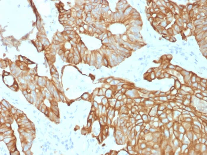 Formalin-fixed, paraffin-embedded human Colon Carcinoma stained with Cytokeratin 19 Antibody (rKRT19/800) - Azide and BSA Free.