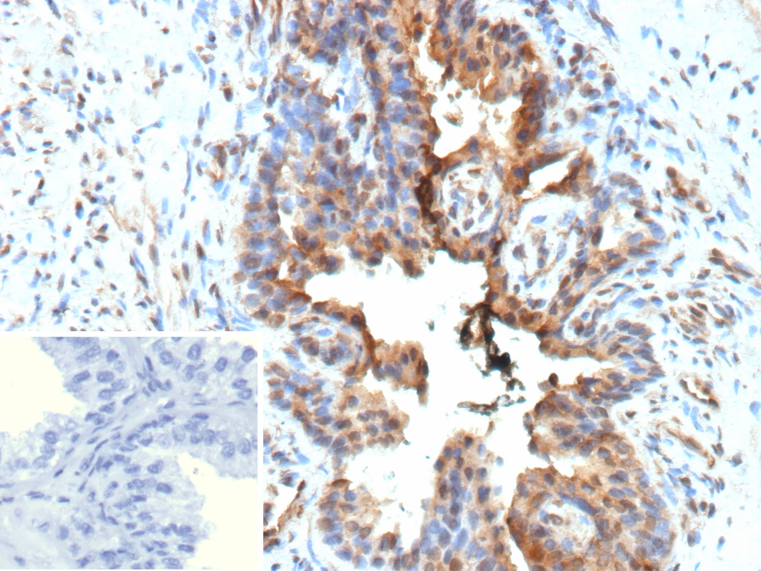 Formalin-fixed, paraffin-embedded human prostate stained with Galectin-3 Antibody (LGALS3/13208R) - Azide and BSA Free. Inset: PBS instead of primary antibody; secondary only negative control. 