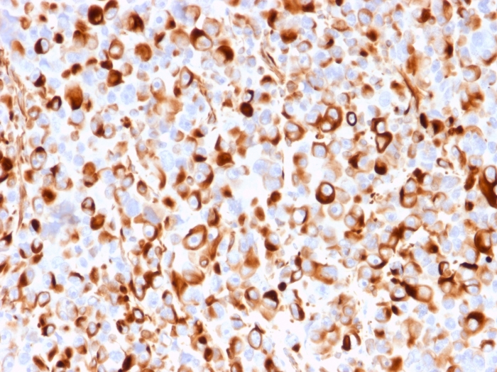 Formalin-fixed, paraffin-embedded human melanoma stained with NGFR/TNFRSF16/p75NTR Antibody (rNGFR/1965) - Azide and BSA Free.