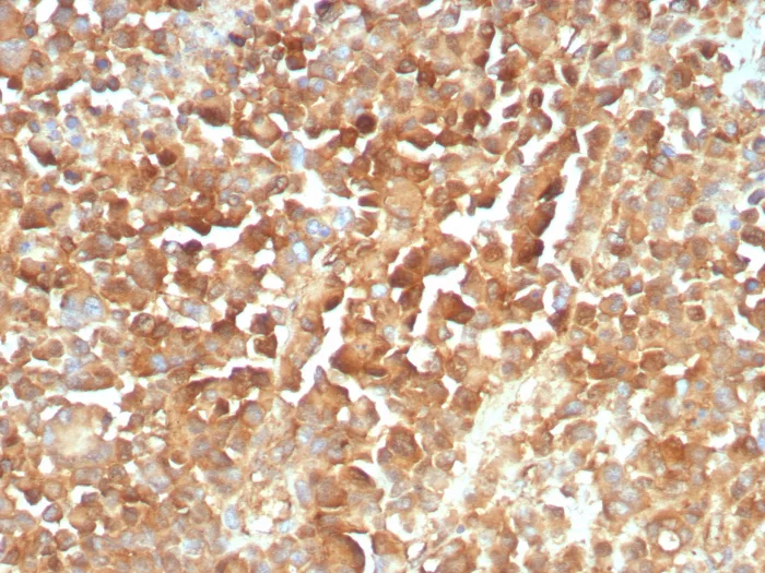 Formalin-fixed, paraffin-embedded human melanoma stained with NGFR/TNFRSF16/p75NTR Antibody (rNGFR/8824) - Azide and BSA Free. HIER: Tris/EDTA, pH9.0, 45min. 2�C: HRP-polymer, 30min. DAB, 5min.