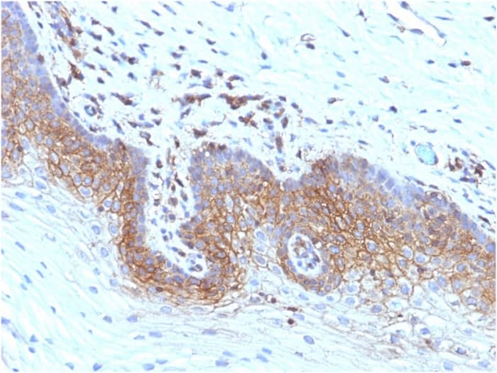 Formalin-fixed, paraffin-embedded human Cervical Carcinoma stained with beta 2-Microglobulin Antibody (rB2M/961) - Azide and BSA Free.