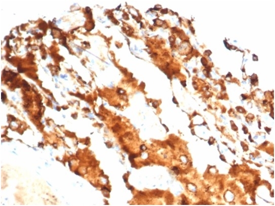 Formalin-fixed, paraffin-embedded human lung carcinoma stained with SP-D Antibody (SFTPD/7084R) - Azide and BSA Free.