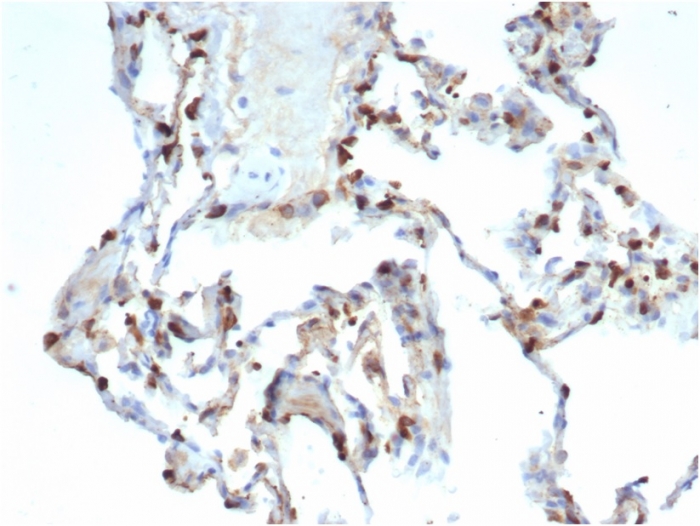 Formalin-fixed, paraffin-embedded human lung carcinoma stained with SP-D Antibody (SFTPD/7086R) - Azide and BSA Free.