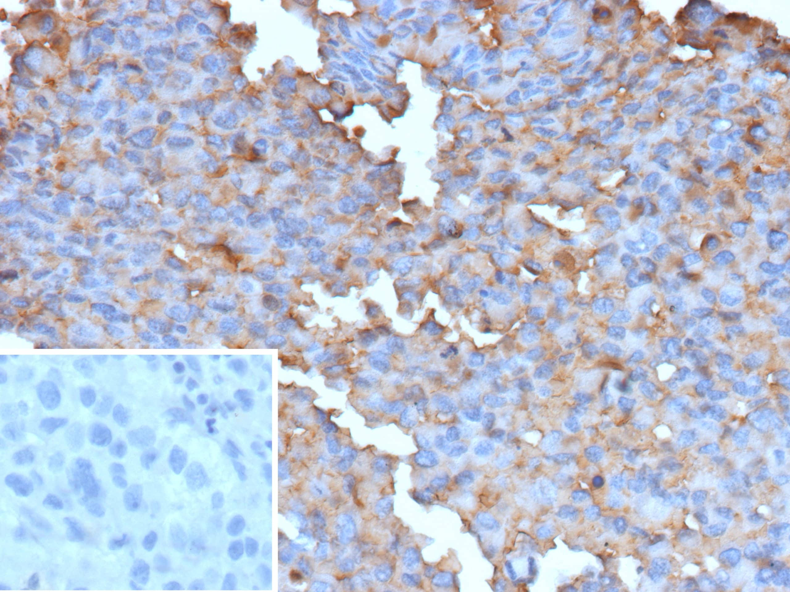 Formalin-fixed, paraffin-embedded human melanoma stained with B-Raf Antibody (BRAF-V600E/13276R) - Azide and BSA Free. Inset: PBS instead of primary antibody; secondary only negative control. 