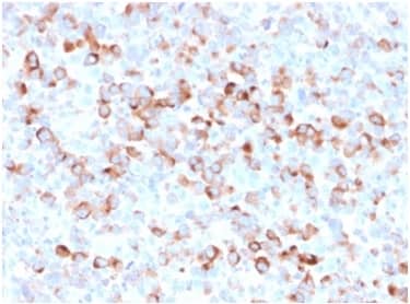 Formalin-fixed, paraffin-embedded Melanoma stained with Tyrosinase Antibody (rOCA1/812) - Azide and BSA Free.