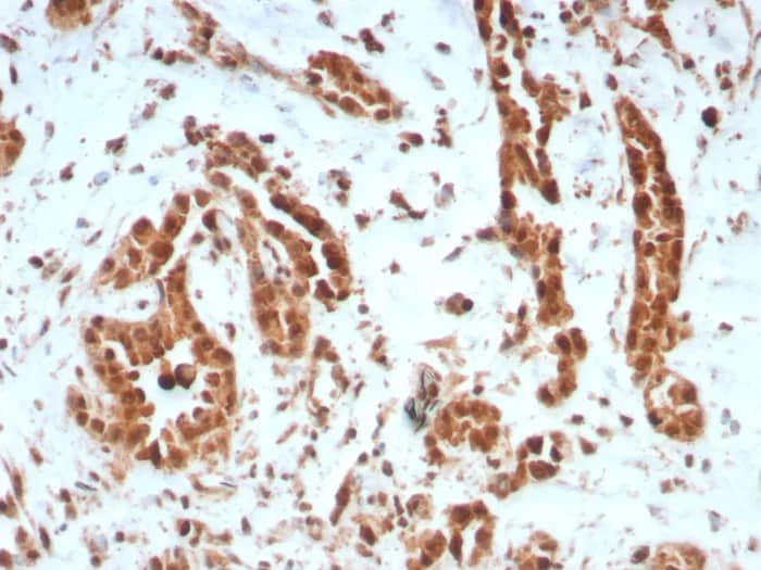 Formalin-fixed, paraffin-embedded human breast carcinoma stained with BAP1 Antibody (BAP1/8959R) - Azide and BSA Free. HIER: Tris/EDTA, pH9.0, 45min. 2�C: HRP-polymer, 30min. DAB, 5min.