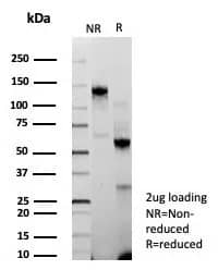 Formalin-fixed, paraffin-embedded human breast carcinoma stained with BAP1 Antibody (BAP1/9120R) - Azide and BSA Free. HIER: Tris/EDTA, pH9.0, 45min. 2�C: HRP-polymer, 30min. DAB, 5min.