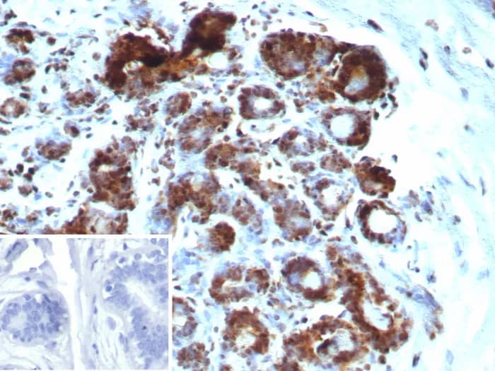 Formalin-fixed, paraffin-embedded human breast carcinoma stained with BAP1 Antibody (BAP1/9120R) - Azide and BSA Free. Inset: PBS instead of primary antibody; secondary only negative control.
