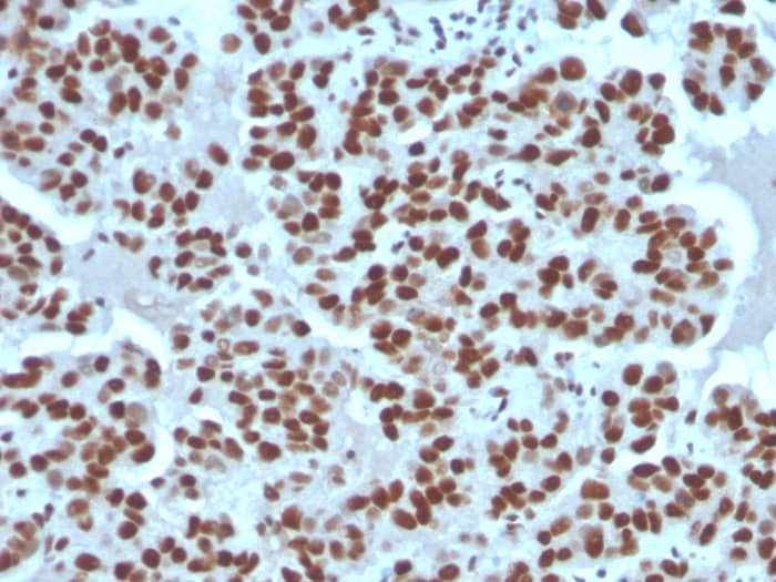 Formalin-fixed, paraffin-embedded human breast carcinoma stained with Cyclin E1 Antibody (rCCNE1/4936) - Azide and BSA Free.