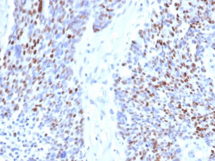 Formalin-fixed, paraffin-embedded human ovarian carcinoma stained with Cyclin E1 Antibody (rCCNE1/4936) - Azide and BSA Free.