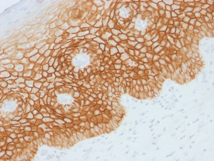 Formalin-fixed, paraffin-embedded human Cervical Squamous Cell Carcinoma stained with CD44, variant 4 Antibody - Azide and BSA Free.