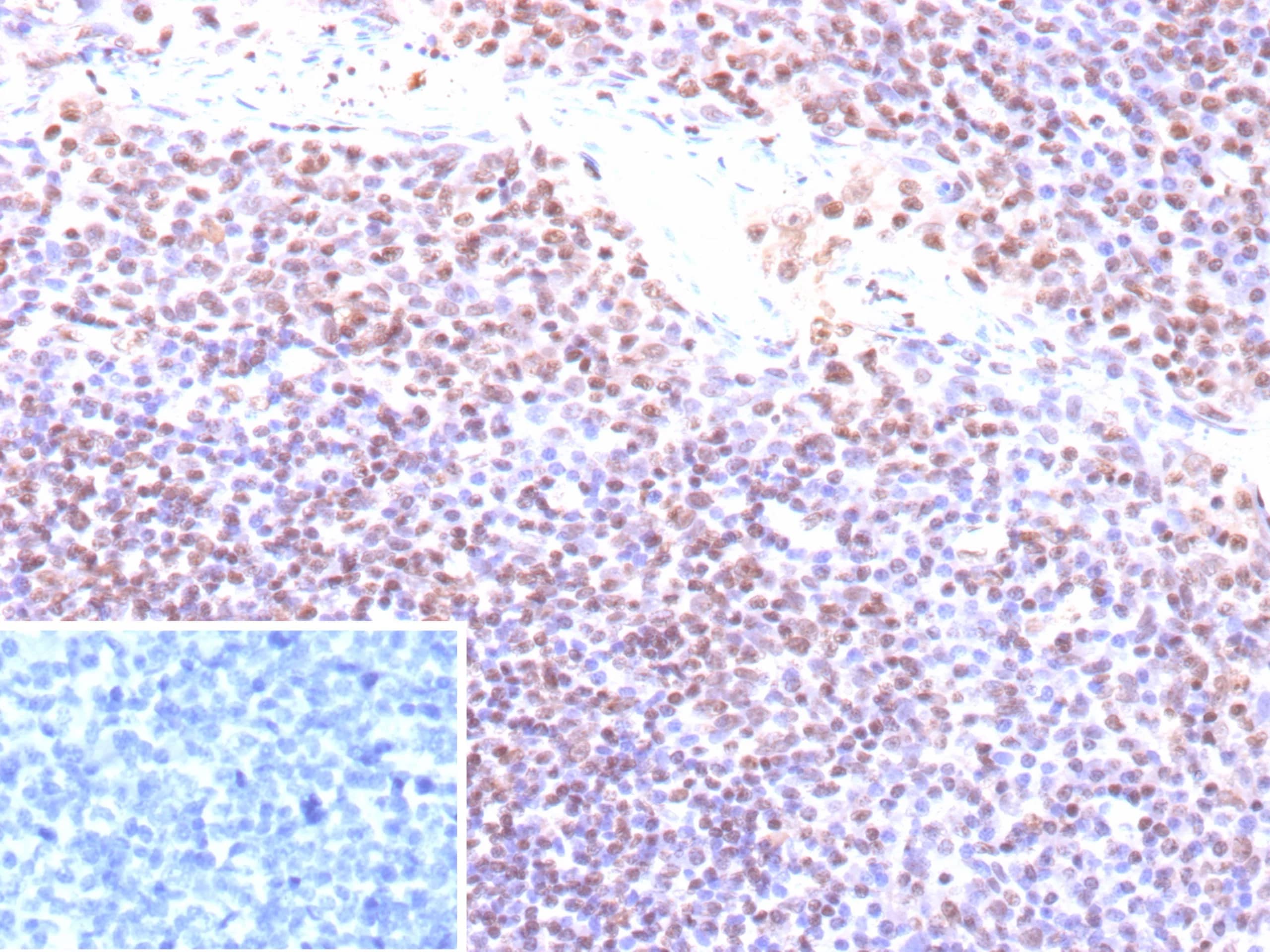 Formalin-fixed, paraffin-embedded human tonsil  stained with Epstein Barr Virus Antibody (EBV/9620R) - Azide and BSA Free. Inset: PBS instead of primary antibody; secondary only negative control. 