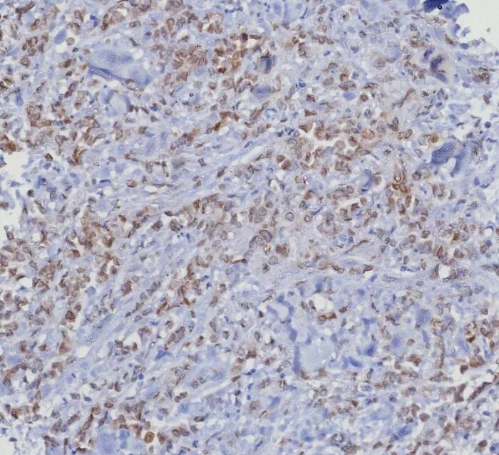 Formalin-fixed, paraffin-embedded human mammary cancer stained with CDK4 Antibody (CDK4/8351R) - Azide and BSA Free. HIER: Tris/EDTA, pH9.0, 45min. 2�C: HRP-polymer, 30min. DAB, 5min.