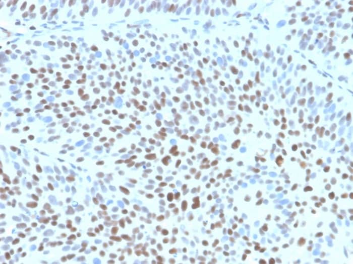 IHC analysis of formalin-fixed, paraffin-embedded human bladder. Strong nuclear staining using p27/Kip1 Antibody (KIP1/1355R) - Azide and BSA Free at 2ug/ml in PBS for 30min RT. HIER: Tris/EDTA, pH9.0, 45min. 2�C: HRP-polymer, 30min. DAB, 5min.