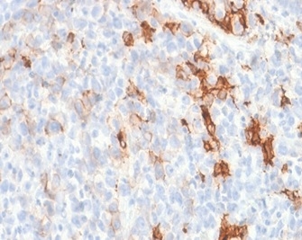 Formalin-fixed, paraffin-embedded human melanoma stained with NGFR/TNFRSF16/p75NTR Antibody (NGFR/1997R) - Azide and BSA Free. HIER: Tris/EDTA, pH9.0, 45min. 2 °: HRP-polymer, 30min. DAB, 5min.