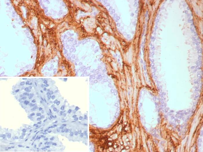 Formalin-fixed, paraffin-embedded human prostate carcinoma stained with Decorin Antibody (rDCN/9075) - Azide and BSA Free. HIER: Tris/EDTA, pH9.0, 45min. 2�C: HRP-polymer, 30min. DAB, 5min.