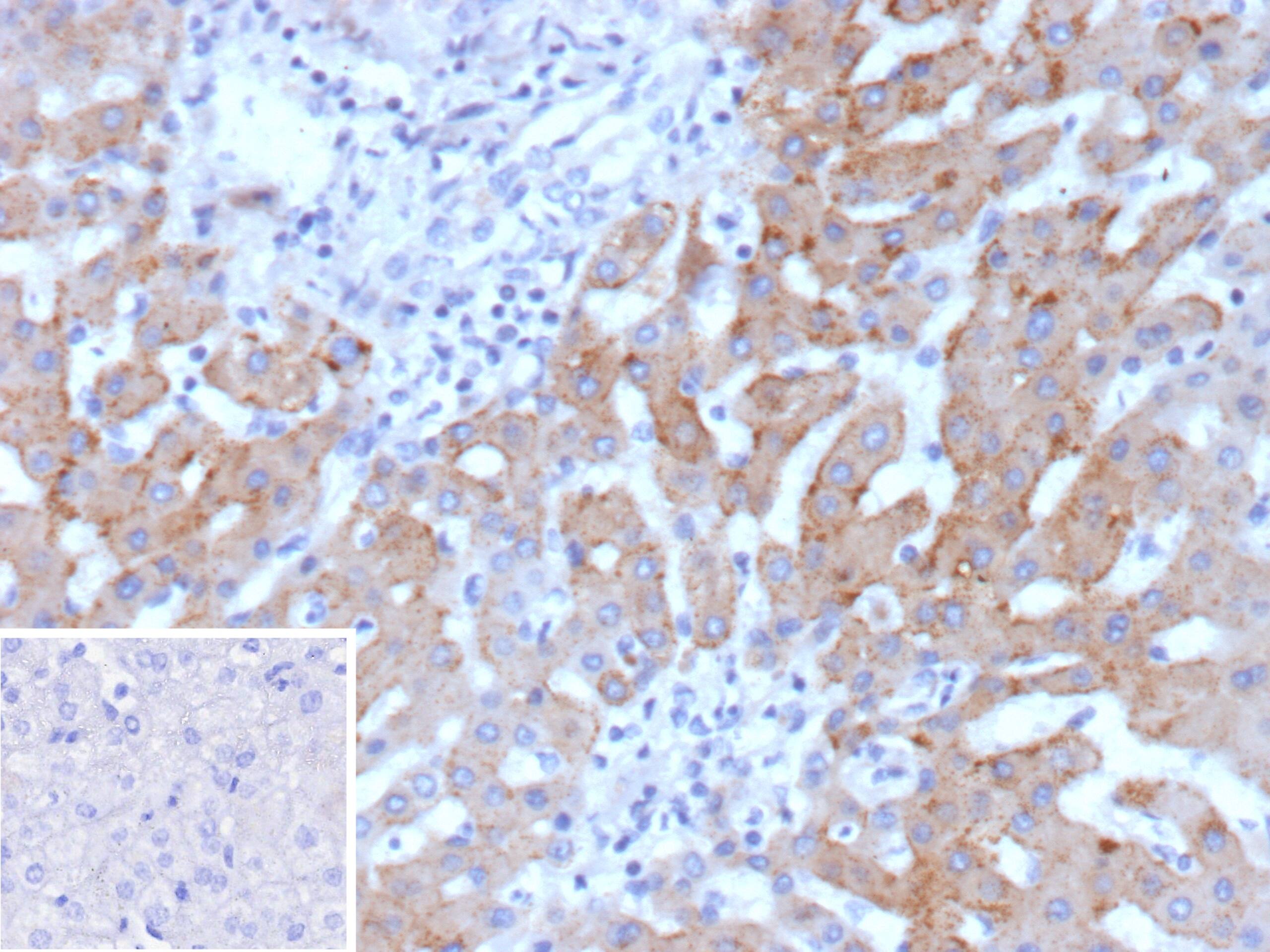 Formalin-fixed, paraffin-embedded human hepatocellular carcinoma stained with HSD17B13 Antibody (HSD17B13/13102) - Azide and BSA Free. Inset: PBS instead of primary antibody; secondary only negative control.