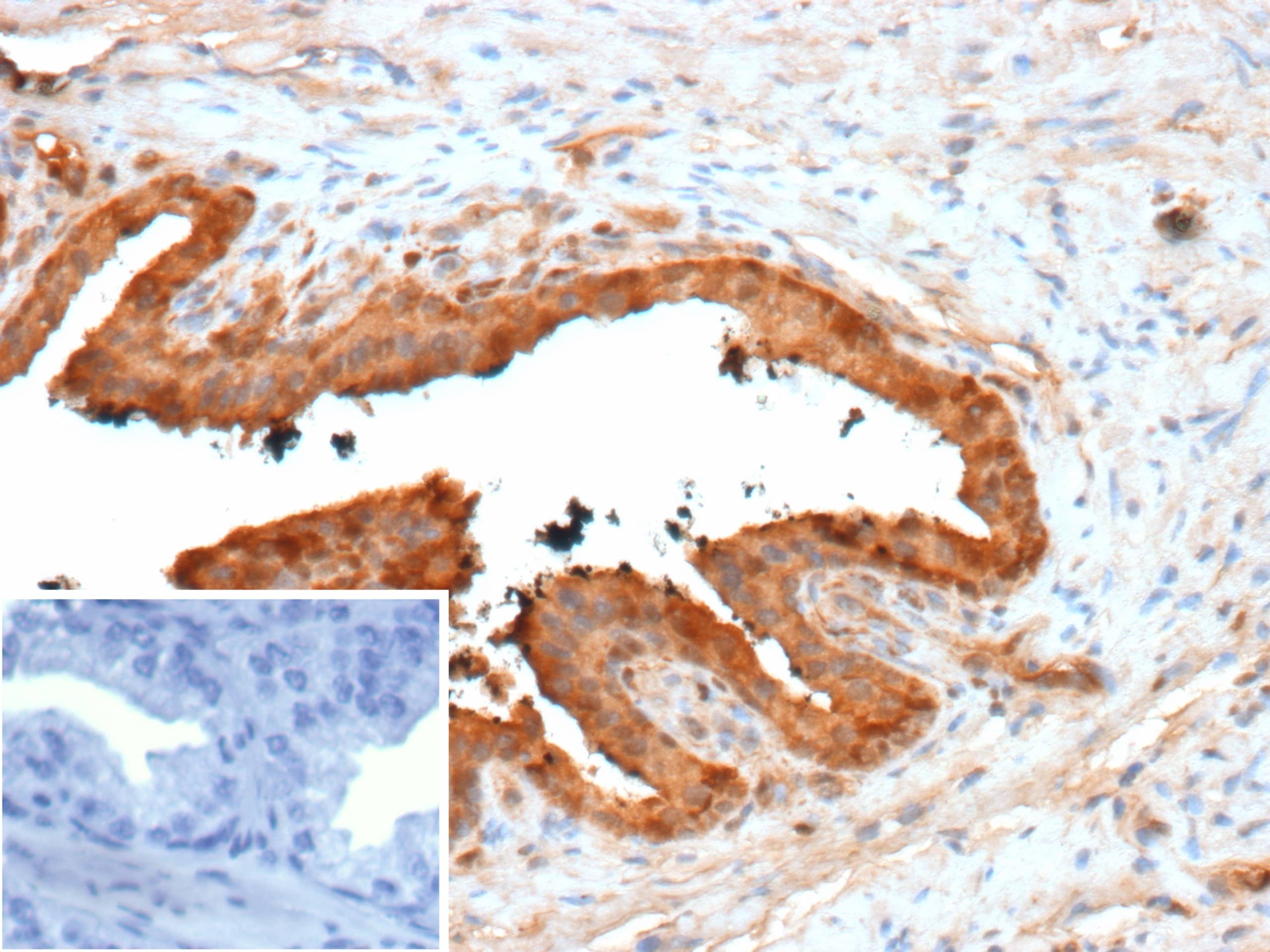 Formalin-fixed, paraffin-embedded human prostate stained with Galectin-3 Antibody (LGALS3/13233R) - Azide and BSA Free. Inset: PBS instead of primary antibody; secondary only negative control. 