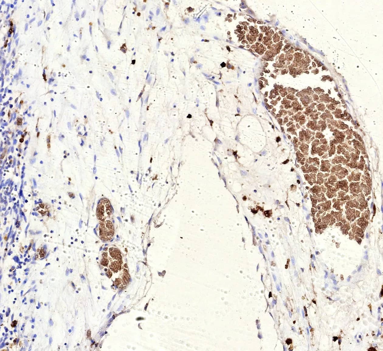 Formalin-fixed, paraffin-embedded human Ewing Sarcoma stained with FLI1 Antibody (rFLI1/9614) - Azide and BSA Free. HIER: Tris/EDTA, pH9.0, 45min. 2 °: HRP-polymer, 30min. DAB, 5min.