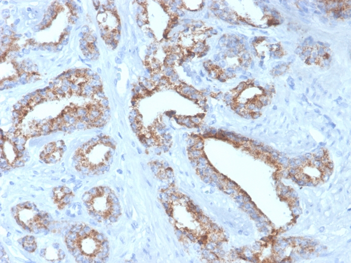 Formalin-fixed, paraffin-embedded human prostate carcinoma stained with alpha-Methylacyl-CoA Racemase/AMACR Antibody (rAMACR/4674) - Azide and BSA Free.