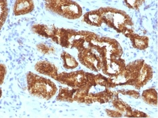 Formalin-fixed, paraffin-embedded human prostate carcinoma stained with alpha-Methylacyl-CoA Racemase/AMACR Antibody (AMACR/3931R) - Azide and BSA Free.